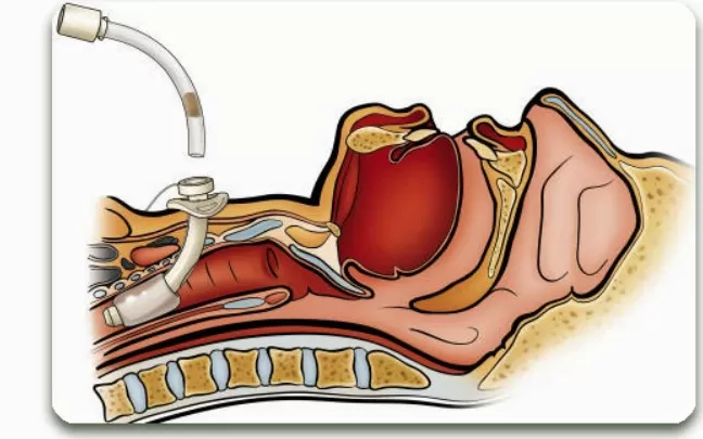 thủ thuật mở kh&iacute; quản